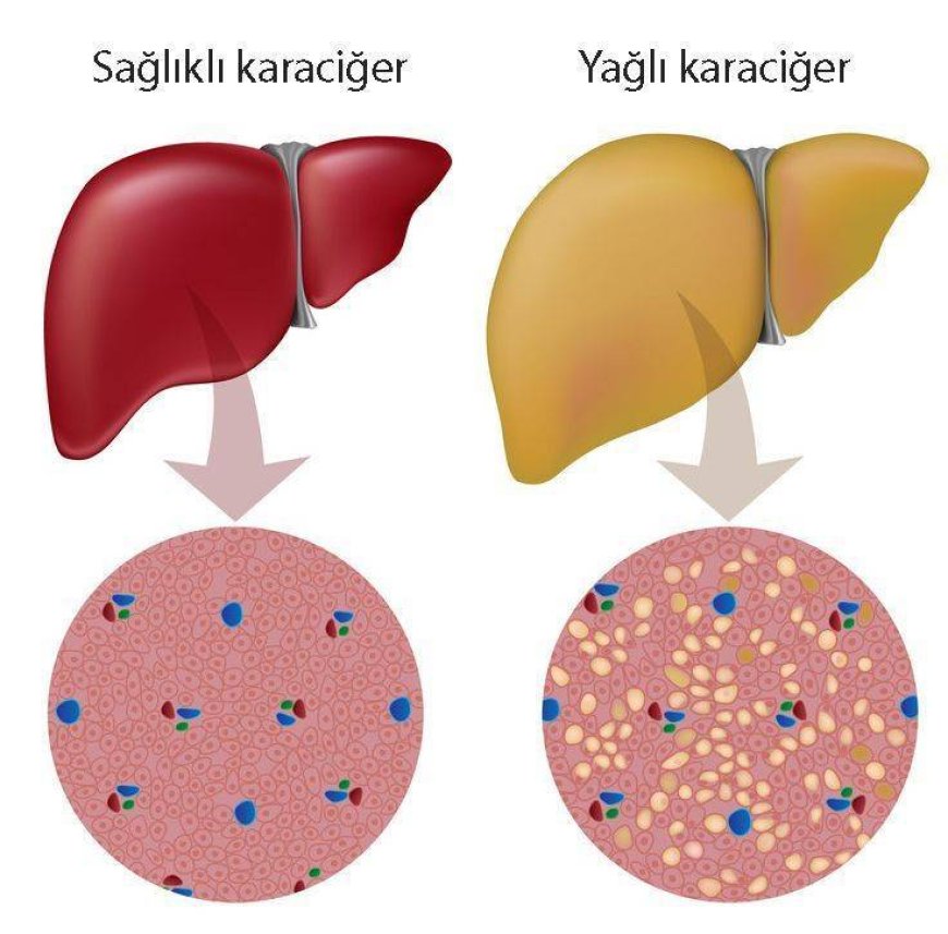 Alkol Dışı Karaciğer Yağlanması (ADKY): Belirtiler, Tanı ve Tedavi