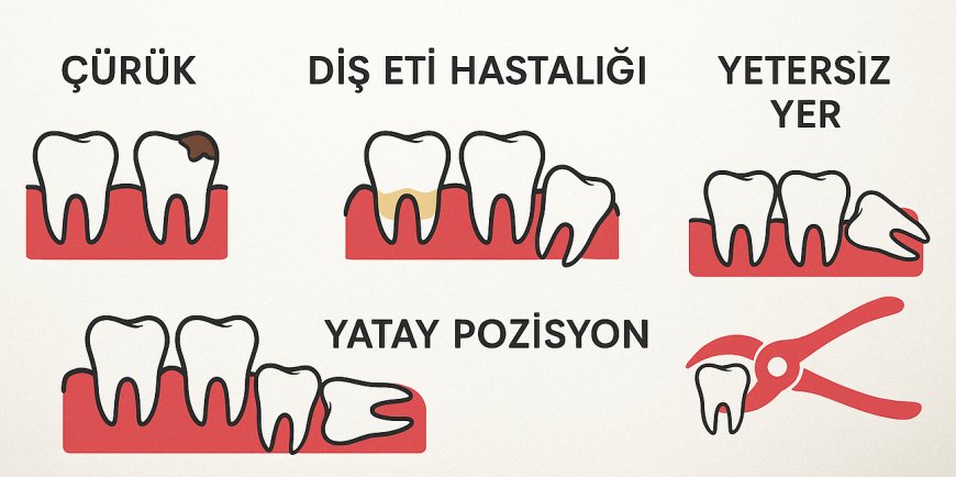 20'LİK DİŞ ÇEKİMİ NE ZAMAN GEREKLİDİR ? ENDİKASYONLAR NELERDİR ?